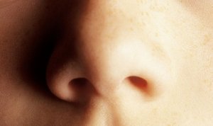 Лечение аномалий развития носа в Индии