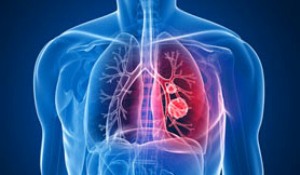 Эмфизема лёгких - лечение в Турции
