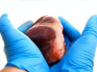 Трансплантация органов в Индии