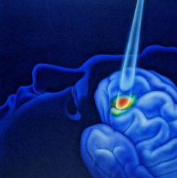 Лазерное лечение опухолей головного мозга в Индии