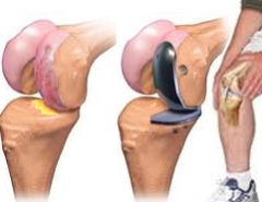 Артроскопия коленного сустава в Индии