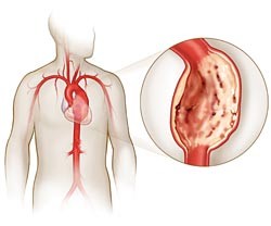 Лечение аневризмы грудной части аорты в Индии