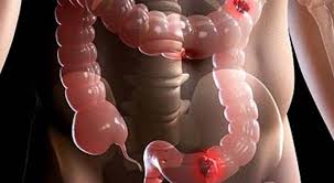 Treatment of colorectal cancer and metostaz in the liver Treatment of colorectal cancer and metostaz in the liver
