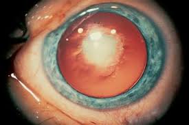 Корковая катаракта