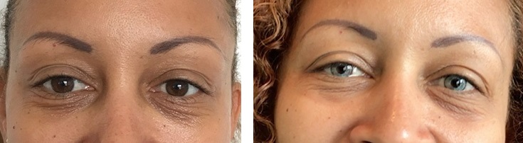 Лазерная операция изменение цвета глаз. Изменение цвета глаз лазером. Изменение цвета глаз лазером. Изменение цвета глаз лазером. Операция на голубые глаза.