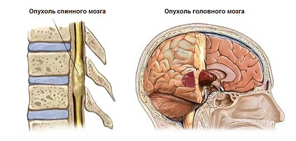 Клиническая картина опухолей головного мозга