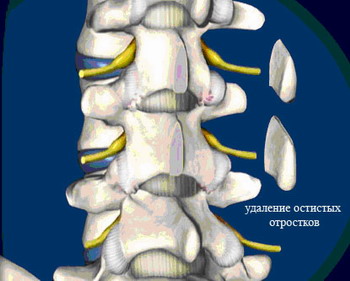 Остистые отростки позвоночника фото
