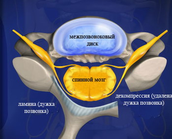 Ламинопластика шейного отдела позвоночника